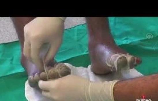 Van'da düzensiz göçmenlerin yaşadığı soğuk yanıkları bilimsel makaleye konu oldu