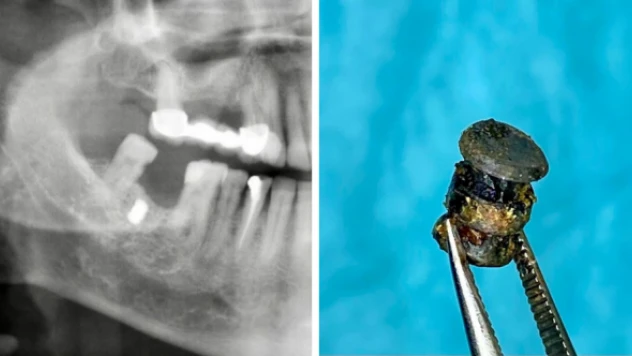 Damağına saplanan metal parçasını 15 yıl sonra öğrendi!