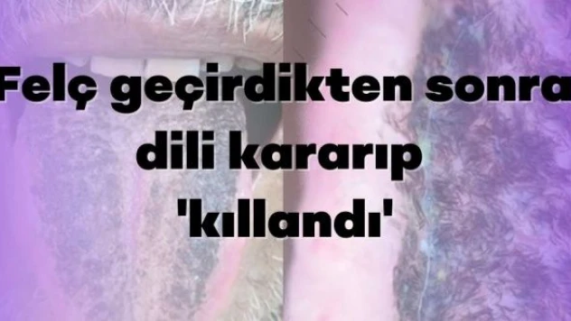 Felç geçirdikten sonra dili kıllandı