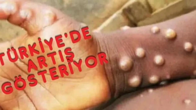 Türkiye'de maymun çiçeği vaka sayısı artış gösteriyor!