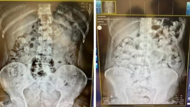 İran uyruklu 5 şüpheli vücudundan çıkanlar polis ve doktoru şaşkına çevirdi