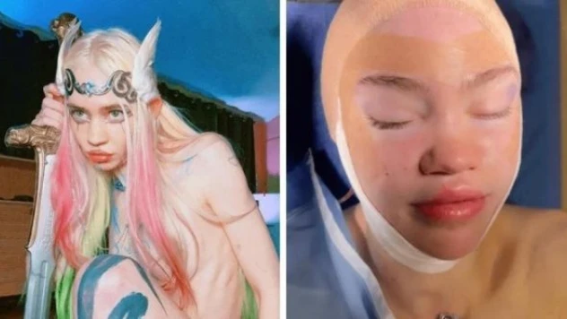 Ünlü şarkıcı elf kulağı yaptırdı