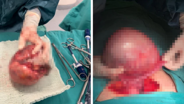 Genç kızın karnından çıkan kitle görenleri şaşkına çevirdi!