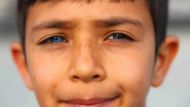 Hayata çift renk bakıyor, görenler hayrete düşüyor