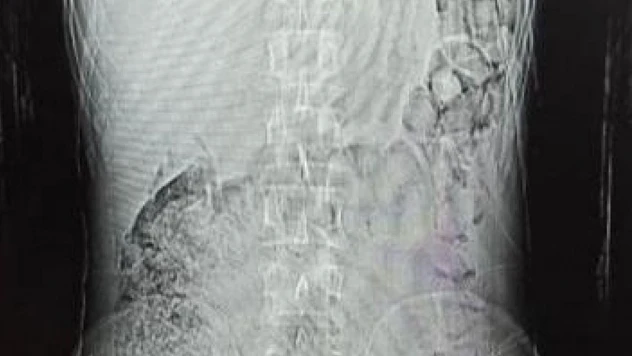 Midesinden 78 kapsül uyuşturucu çıktı