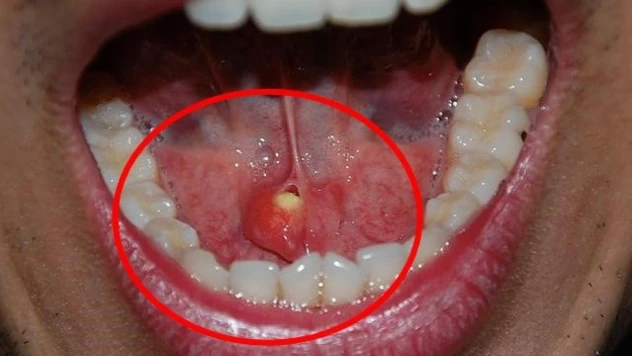 Sessiz tehlike ağızda gizleniyor