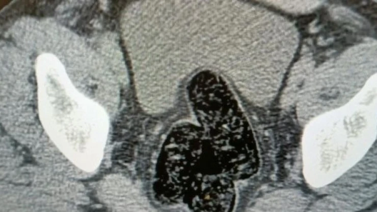 Bağırsağında uyuşturucu taşıdı, bakın nasıl yakalandı?