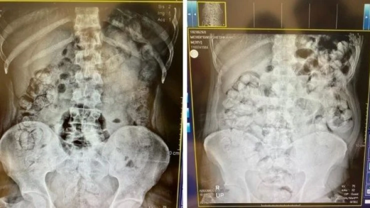 İran uyruklu 5 şüpheli vücudundan çıkanlar polis ve doktoru şaşkına çevirdi