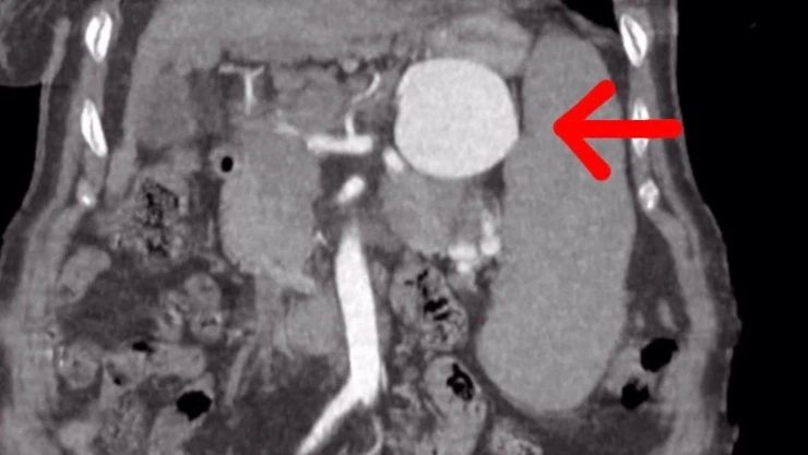 Dalak damarında 7 santim baloncuk oluşan 75 yaşındaki hasta sağlığına kavuştu