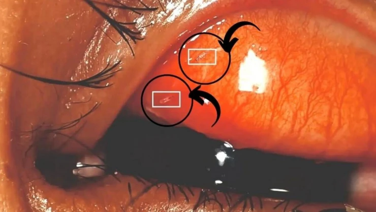 Hastanın gözünden çıkanlar şoke etti